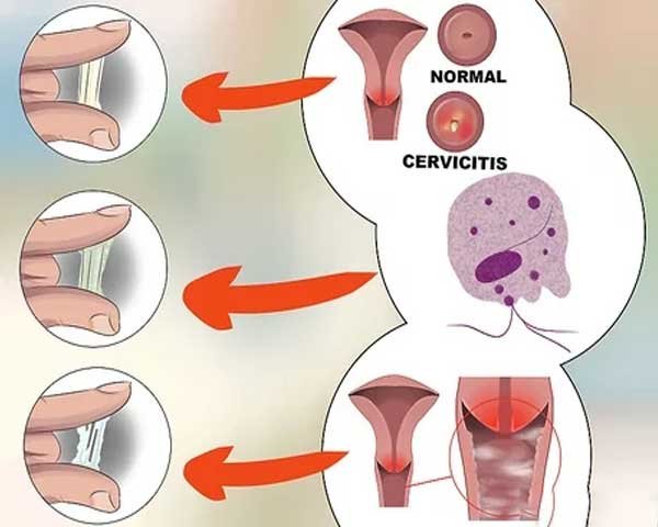 Abnormal Vaginal Discharge (Leucorrhoea)