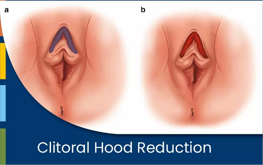 Clitoral Hood Reduction