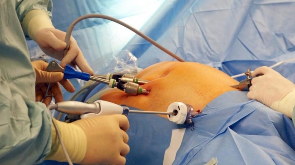 Diagnostic Hystero-Laparoscopy