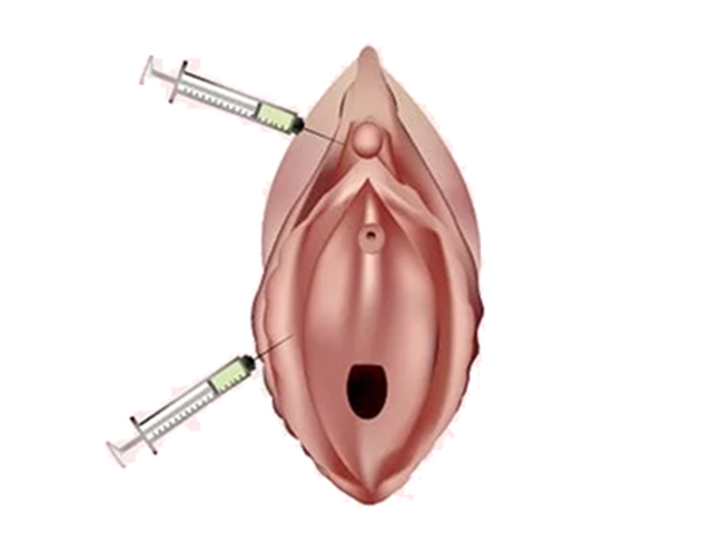 Female Sexual Enhancement Procedures