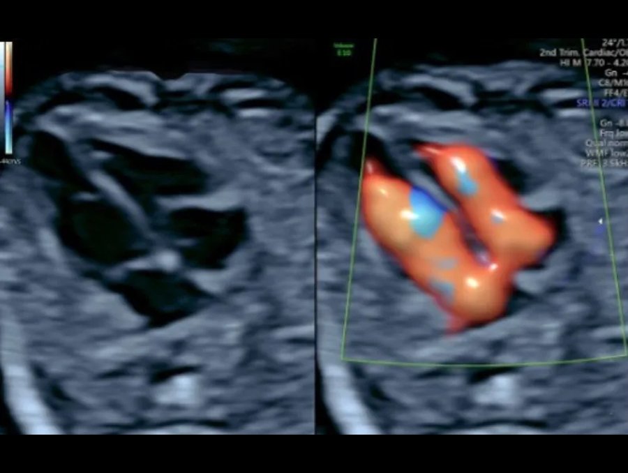 Fetal Echo (22- 24 weeks)