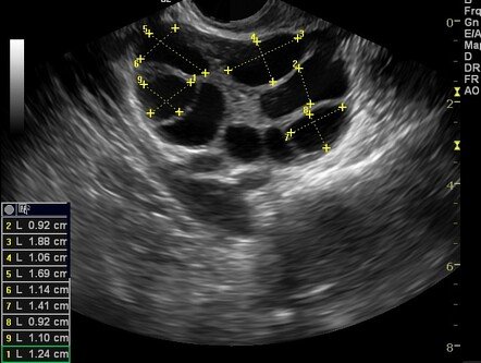 Follicular Monitoring / Ovulation Study (TVS)