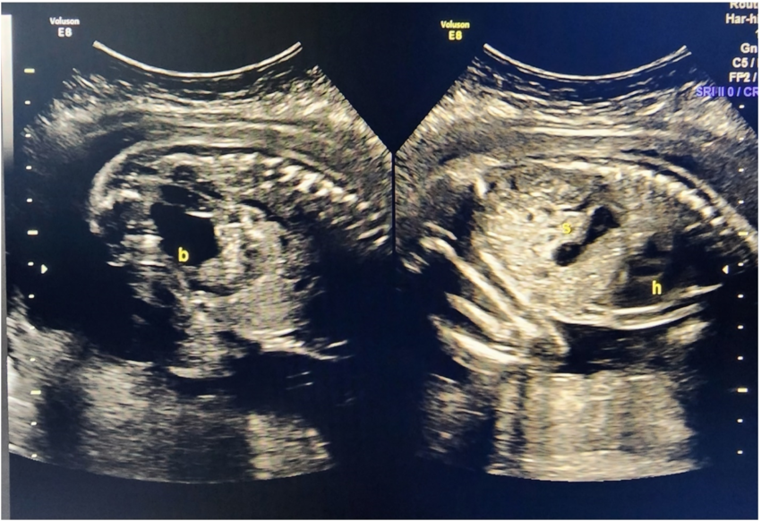 Growth Scans for Fetal Well Being