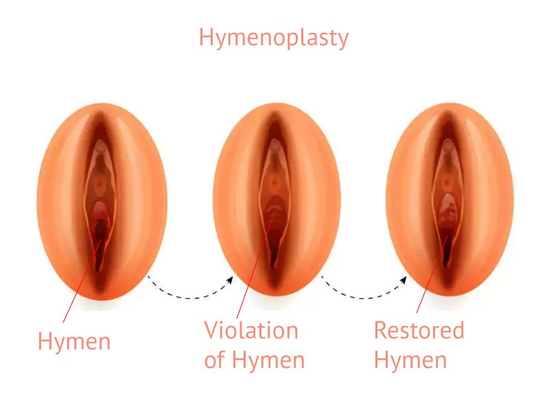 Hymenoplasty (Hymen Repair Surgery)