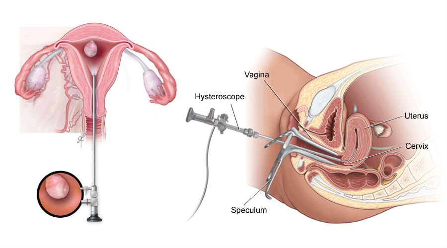 Hysteroscopic Removal of Copper T