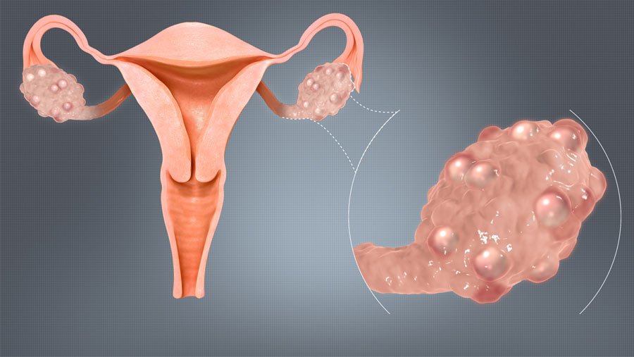 Laparoscopic Ovarian Drilling for PCOS