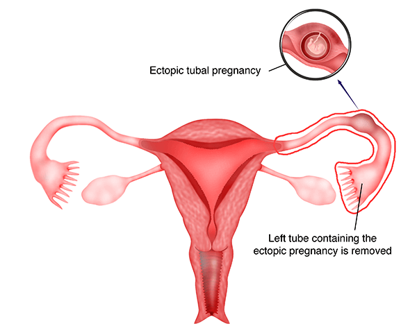 Laparoscopic salpingectomy for ectopic pregnancy