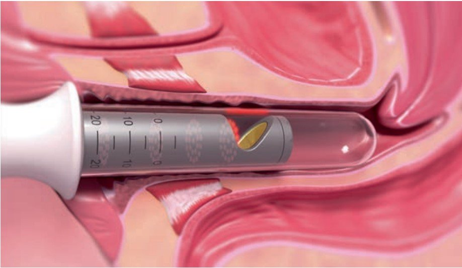 Laser for SUI (Stress Urinary Incontinence)