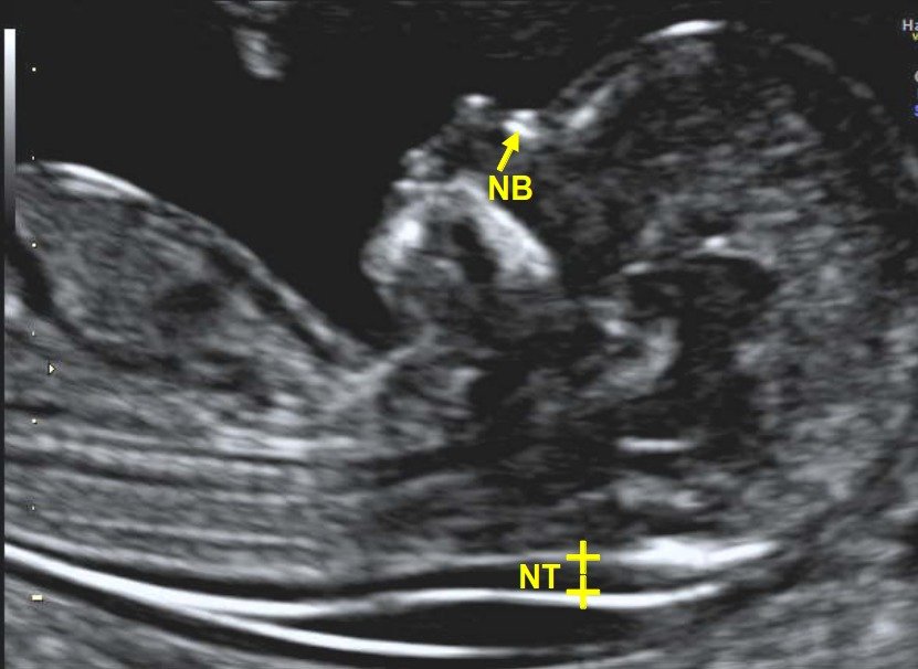 NTNB Scan (11- 13+6 weeks)