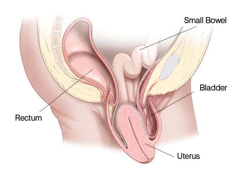 Uterine Prolapse