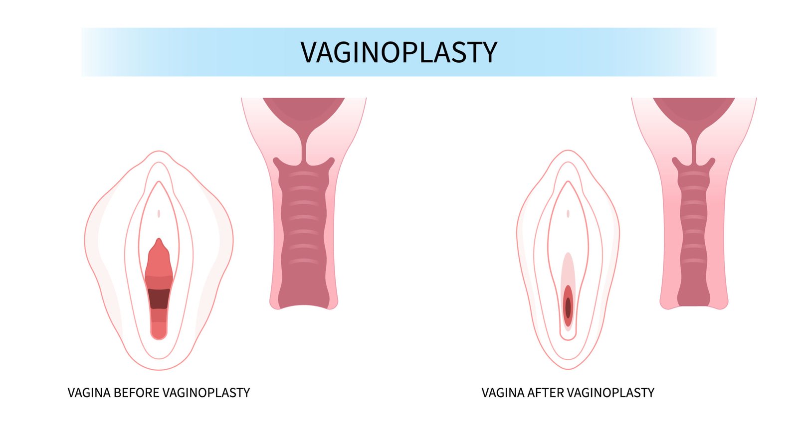 Vaginoplasty