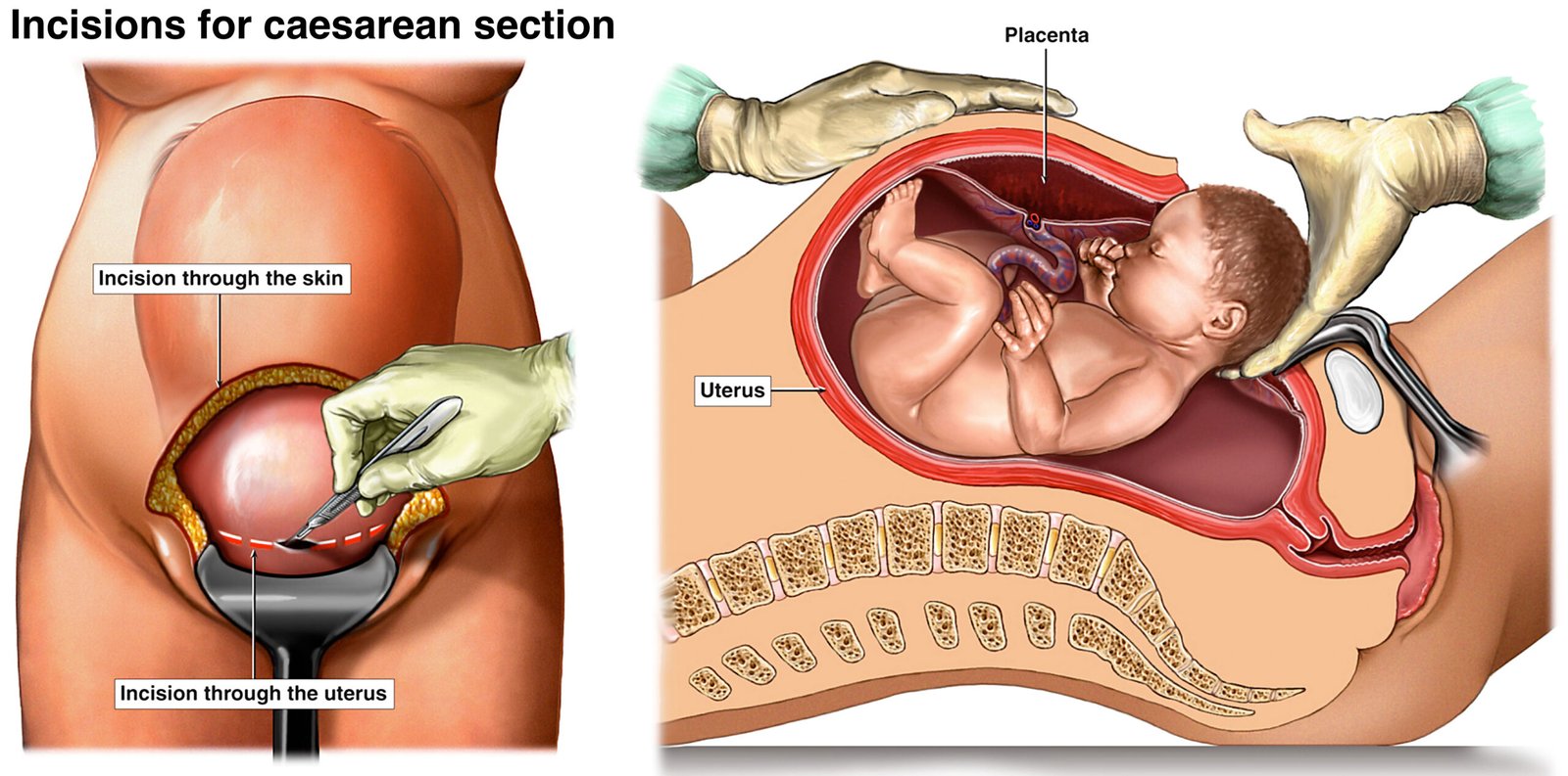 cesarean section delivery surgery