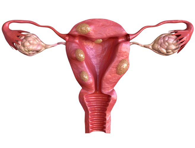 fibroids