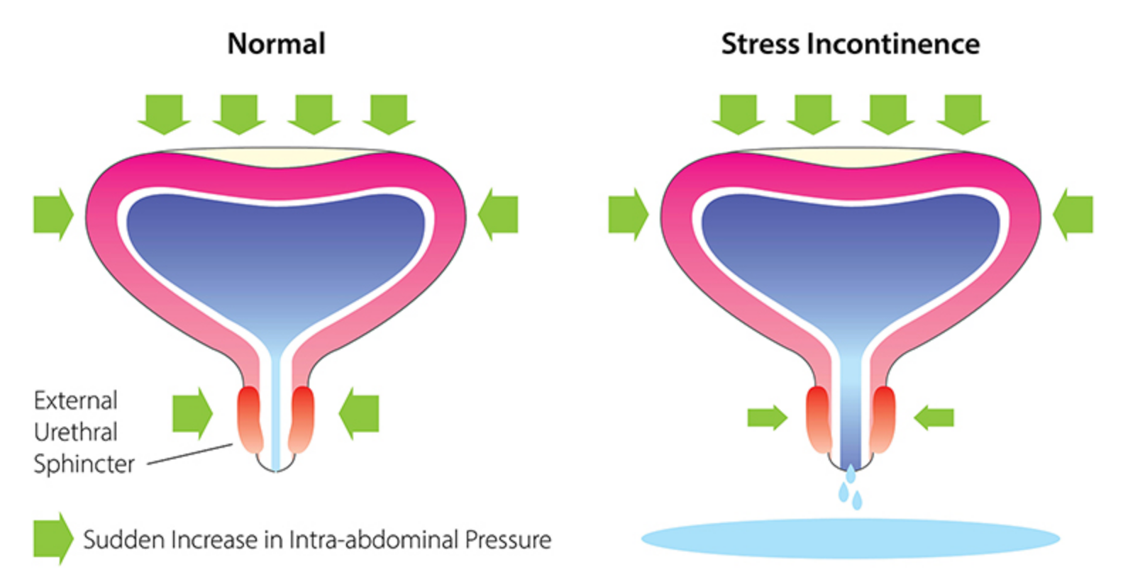 stress urinary incontinence (sui)