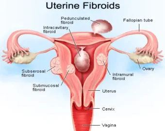 Best Doctor For Fibroids In Nagpur