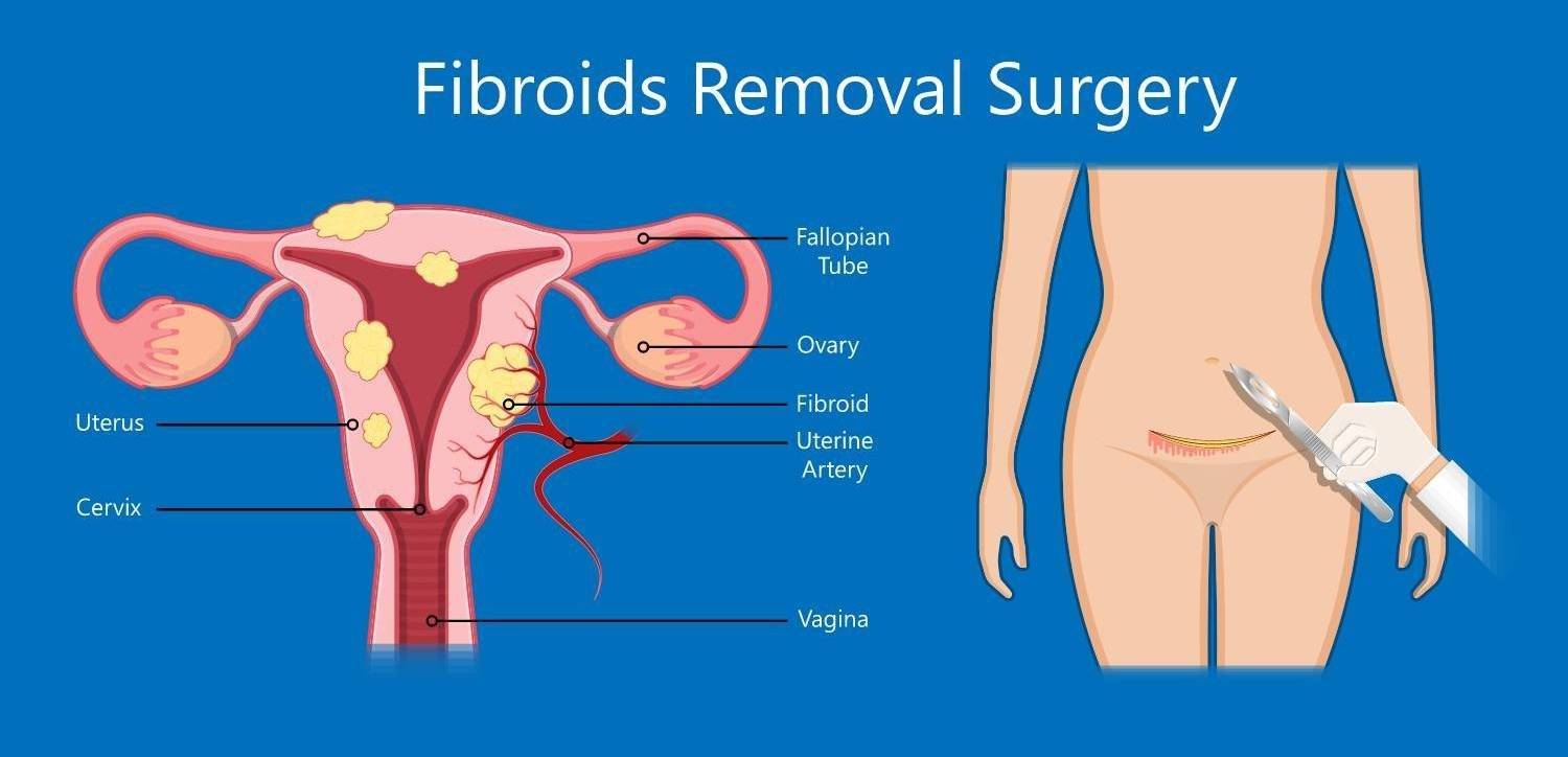 Fibroid Removal Surgery In Nagpur