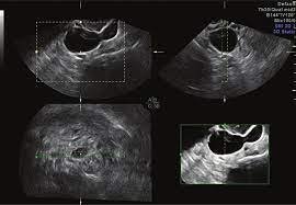 Gynec Ultrasound In Nagpur