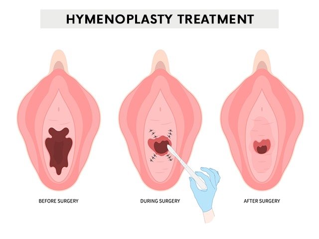 Hymenoplasty In Nagpur