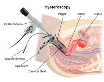 Hysteroscopic Surgeon In Nagpur