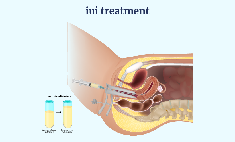 IUI Treatment Cost In Nagpur