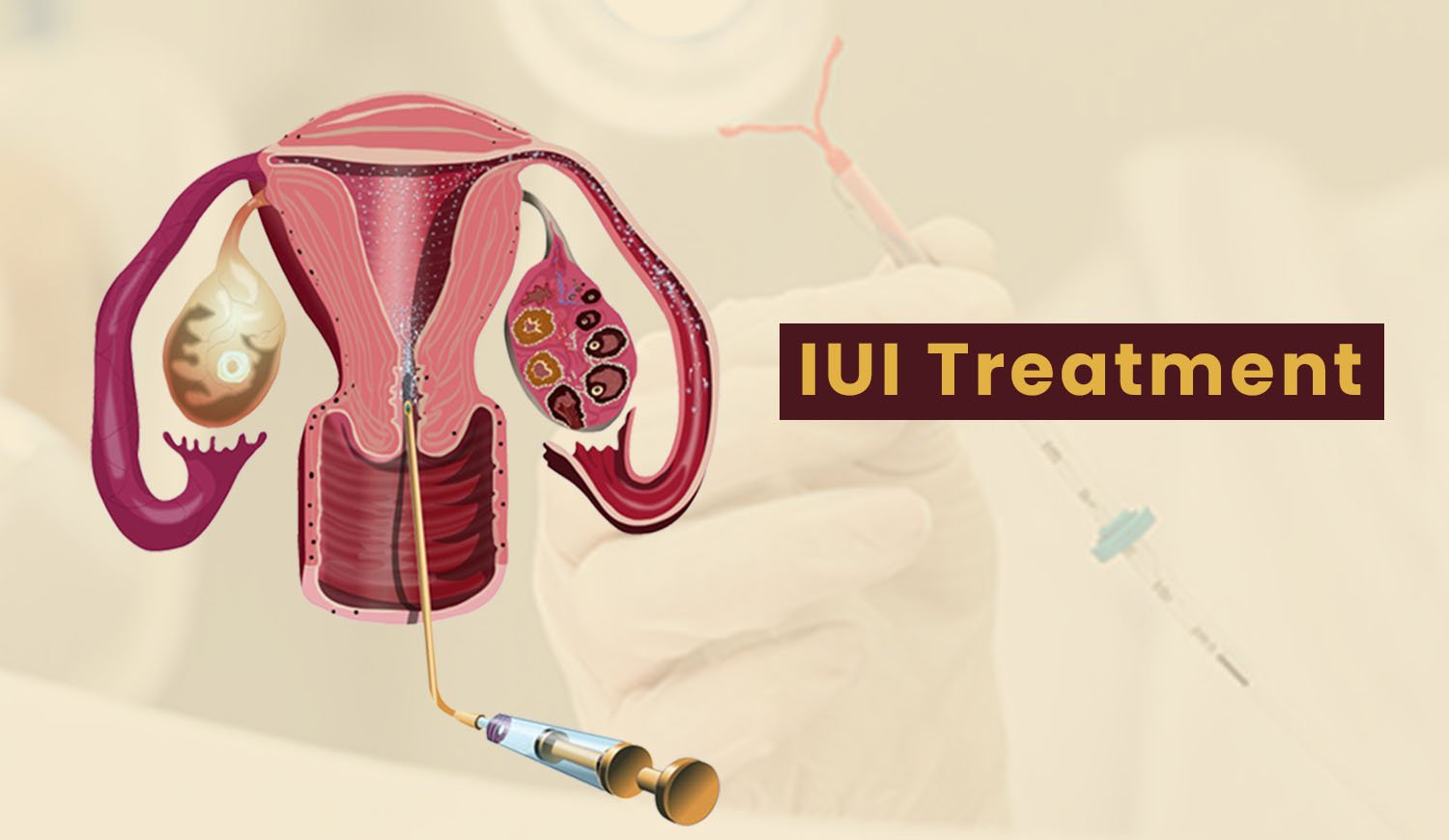 IUI Treatment In Nagpur