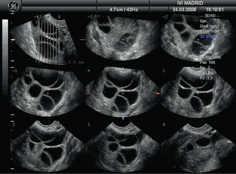 Infertility Ultrasound Specialist In Nagpur