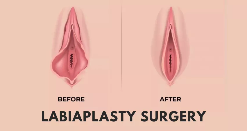 Labiaplasty Surgery In Nagpur