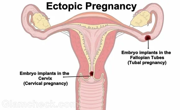 Laparoscopic Ectopic Pregnancy Treatment In Nagpur