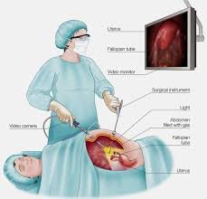 Laparoscopic Endometriosis Surgery In Nagpur