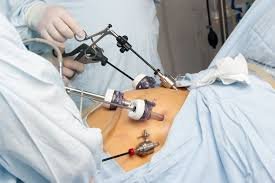 Laparoscopic Fibroid Removal Surgery In Nagpur