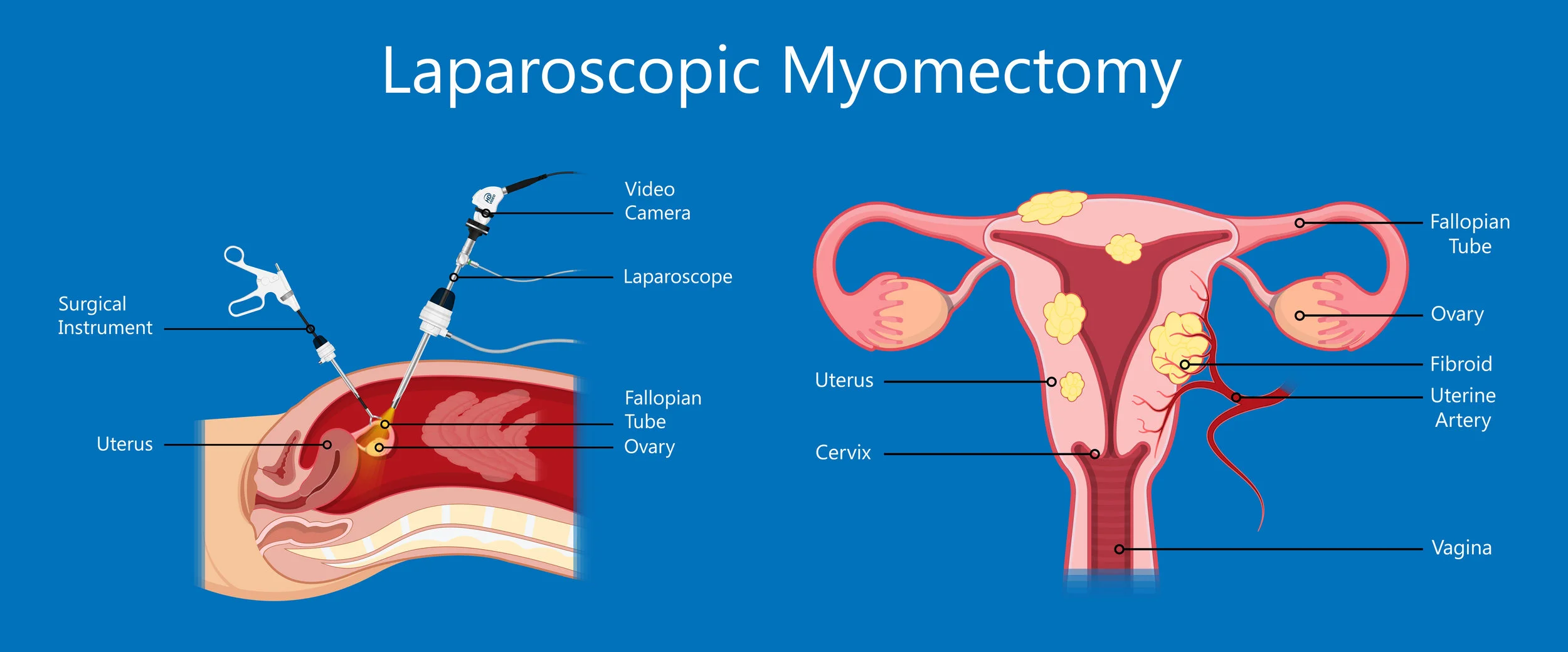 Laparoscopic Myomectomy In Nagpur