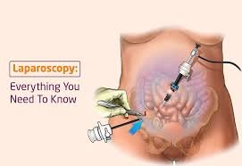 Laparoscopic Treatment For Fallopian Tube Block In Nagpur