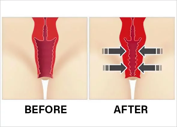 Laser Vaginal Tightening In Nagpur