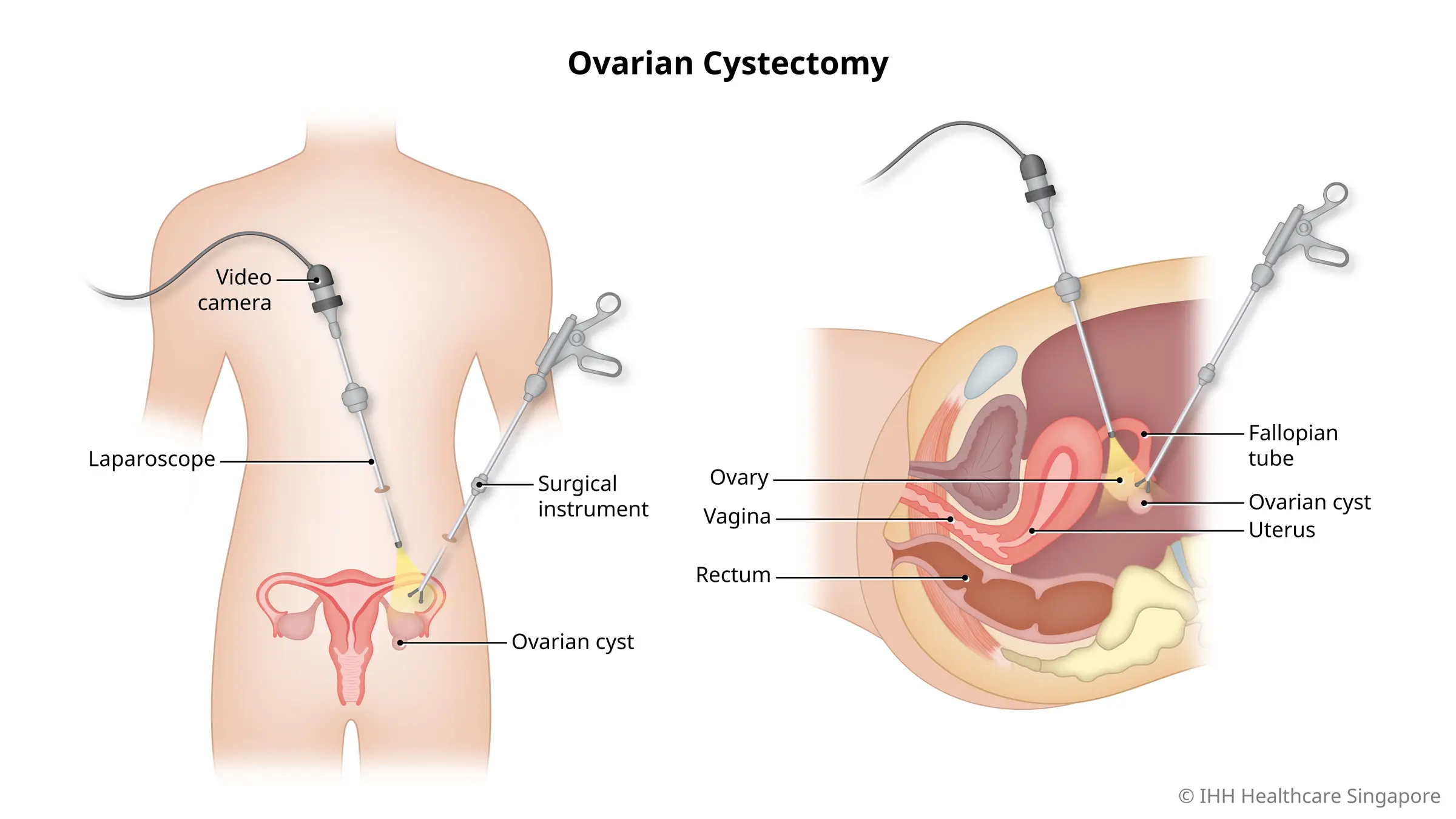 Ovarian Cyst Treatment with laser In Nagpur