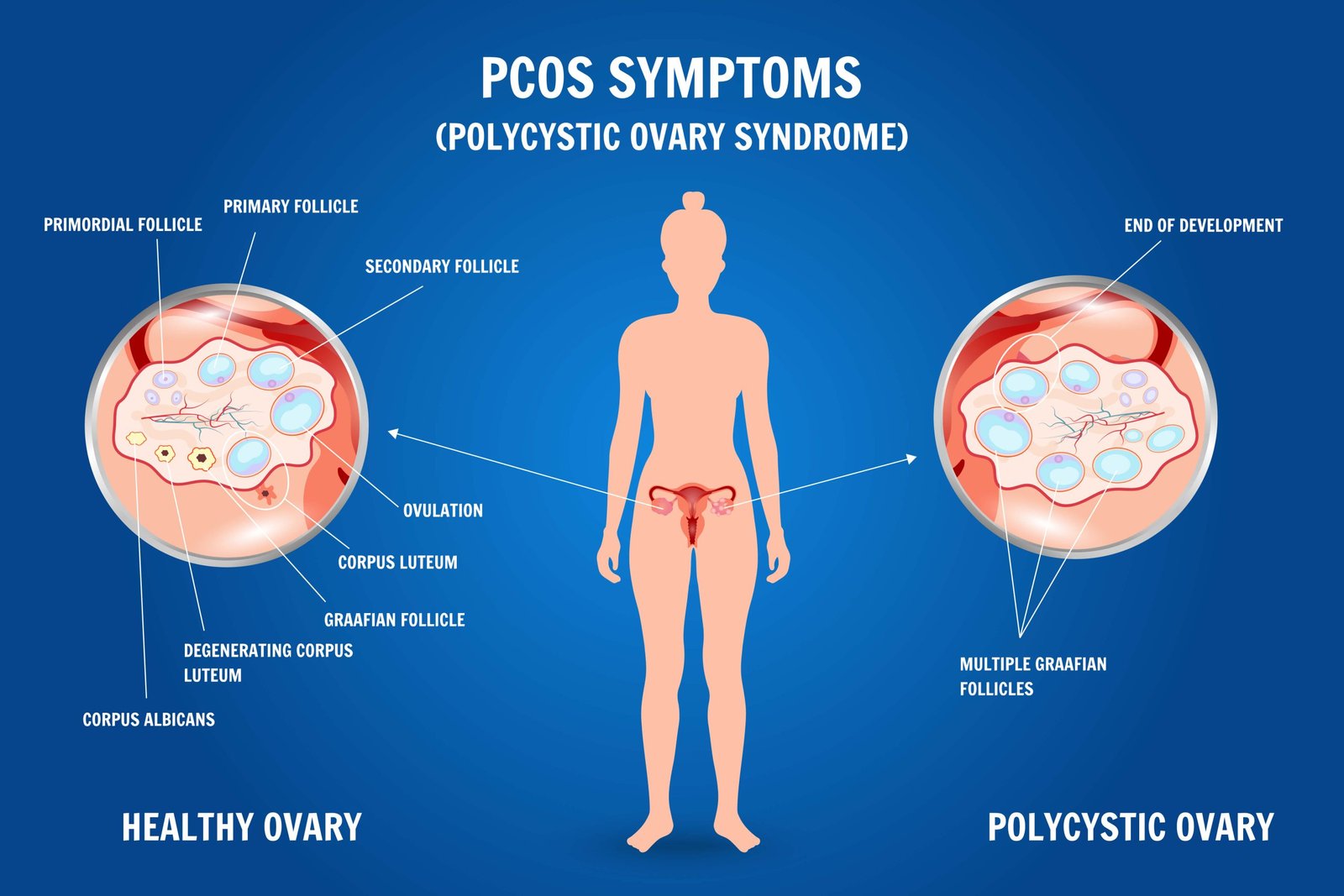 PCOS Treatment Doctor In Nagpur