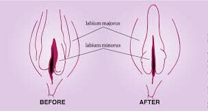 Prp Treatment For Vaginal Tightening In Nagpur