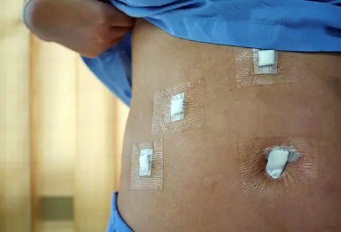 Recovery After Laparoscopic Surgery In Nagpur