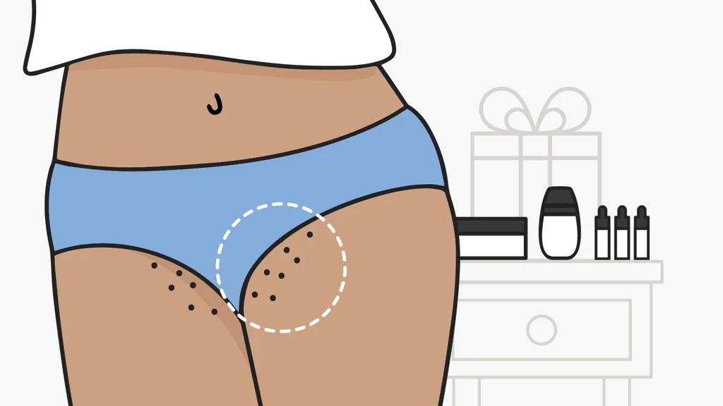 Treatment For Intimate Area Pigmentation In Nagpur