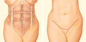 Tummy Tucking Surgery In Nagpur