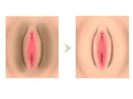 Vaginal Lightening Treatment In Nagpur