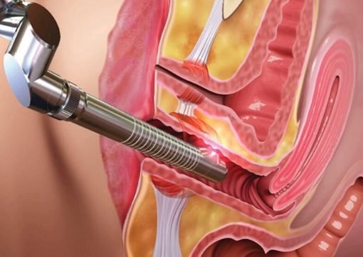 Laser Vaginoplasty Treatment Nagpur